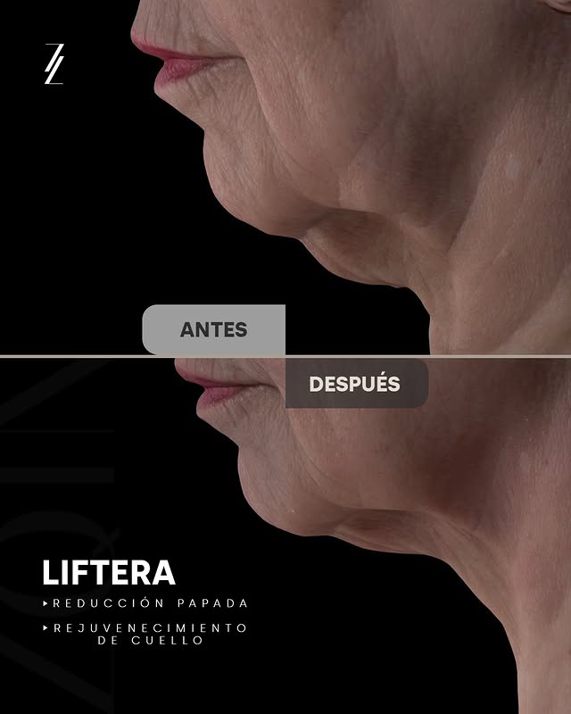 Antes y después de tratamiento Liftera HIFU en papada y cuello — ZQIN Clinic